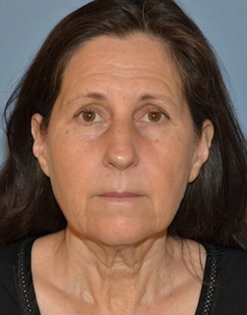 Lower Face & Neck Lift Before & After Gallery - Patient 313044 - Image 1