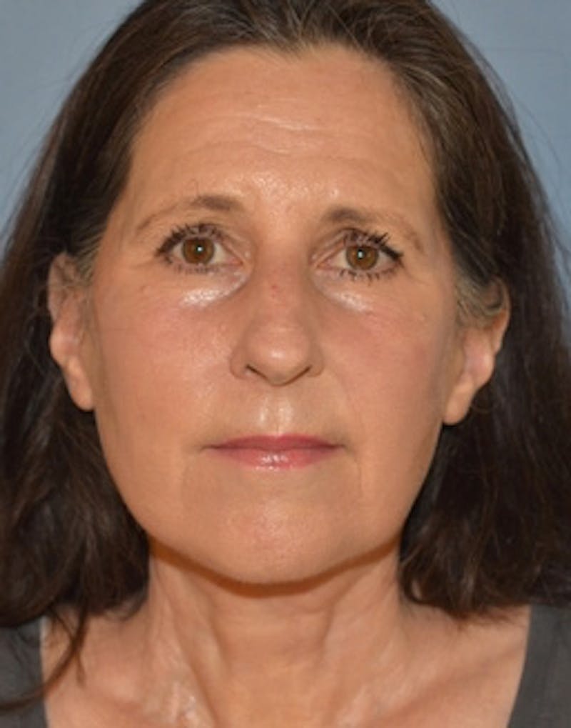 Lower Face & Neck Lift Before & After Gallery - Patient 313044 - Image 2
