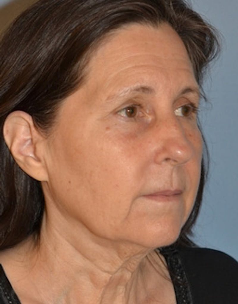 Lower Face & Neck Lift Before & After Gallery - Patient 313044 - Image 3