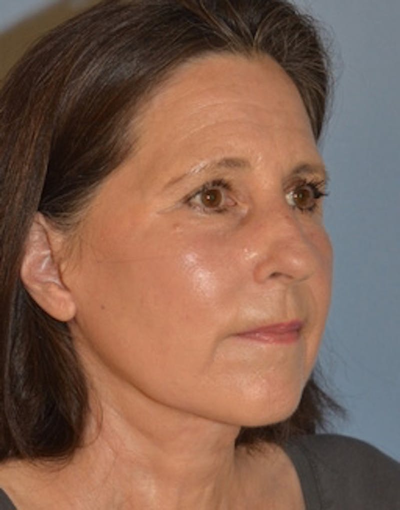 Lower Face & Neck Lift Before & After Gallery - Patient 313044 - Image 4
