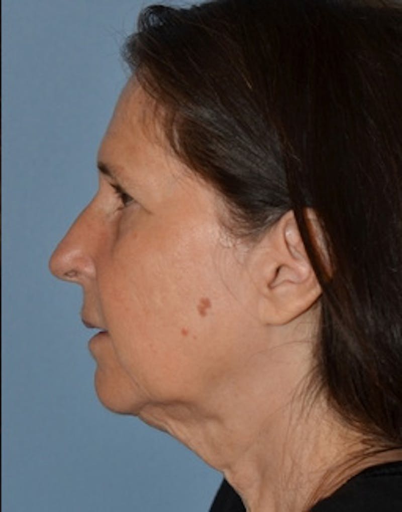 Lower Face & Neck Lift Before & After Gallery - Patient 313044 - Image 5