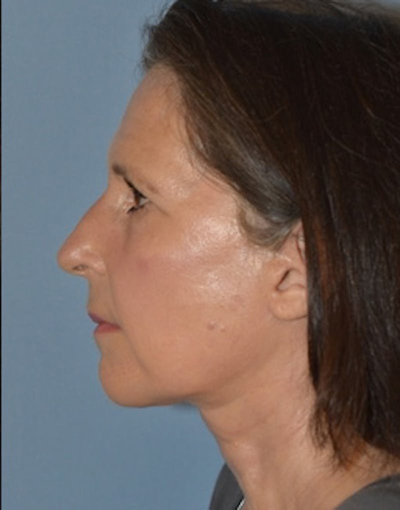 Lower Face & Neck Lift Before & After Gallery - Patient 313044 - Image 6