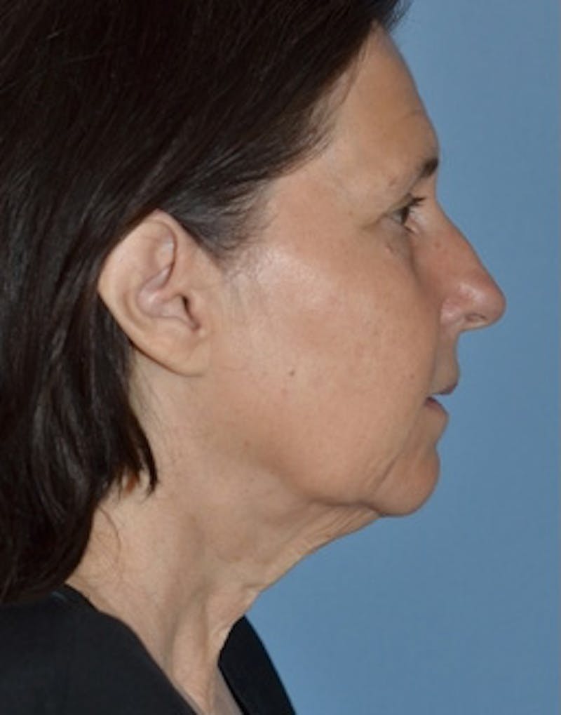 Lower Face & Neck Lift Before & After Gallery - Patient 313044 - Image 7