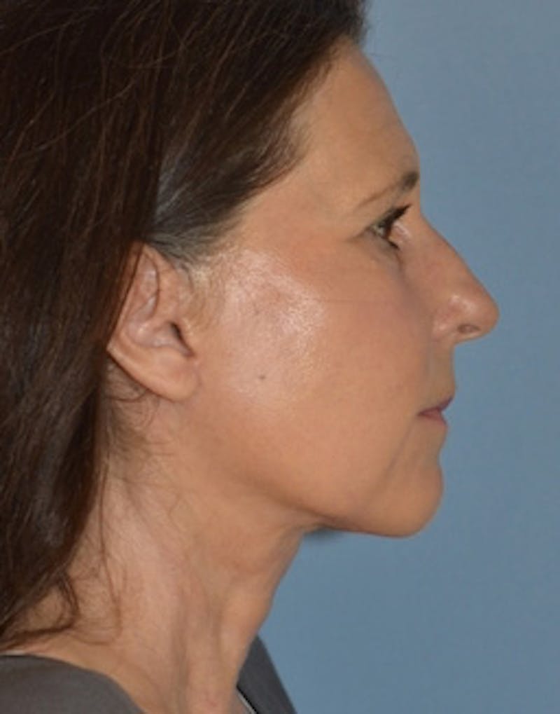 Lower Face & Neck Lift Before & After Gallery - Patient 313044 - Image 8
