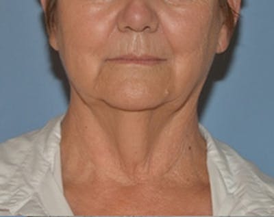 Lower Face & Neck Lift Before & After Gallery - Patient 344842 - Image 1
