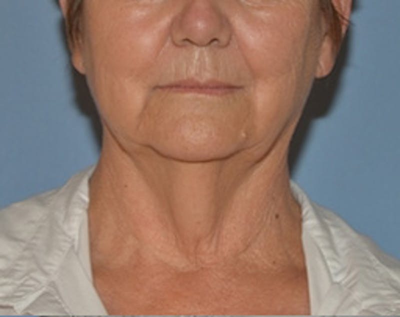 Lower Face & Neck Lift Before & After Gallery - Patient 344842 - Image 1