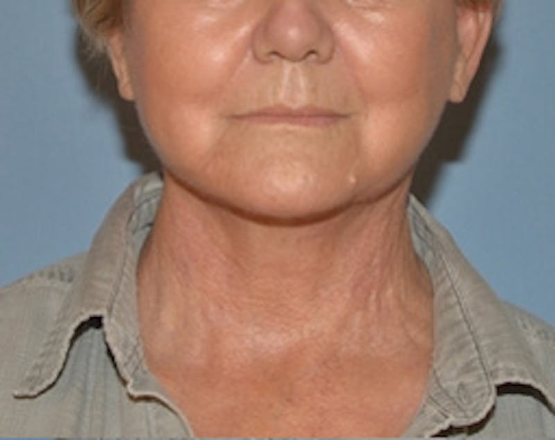 Lower Face & Neck Lift Before & After Gallery - Patient 344842 - Image 2