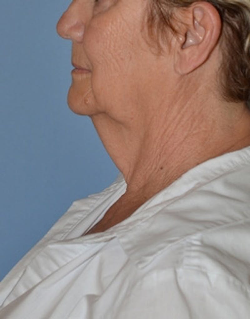 Lower Face & Neck Lift Before & After Gallery - Patient 344842 - Image 3