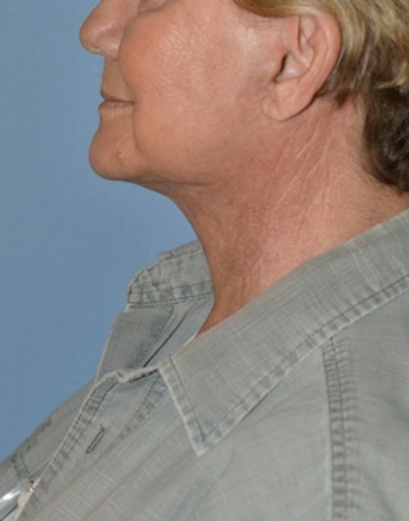 Lower Face & Neck Lift Before & After Gallery - Patient 344842 - Image 4