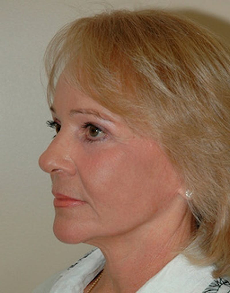 Lower Face & Neck Lift Before & After Gallery - Patient 603574 - Image 4