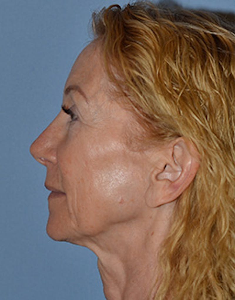 Lower Face & Neck Lift Before & After Gallery - Patient 199967 - Image 1