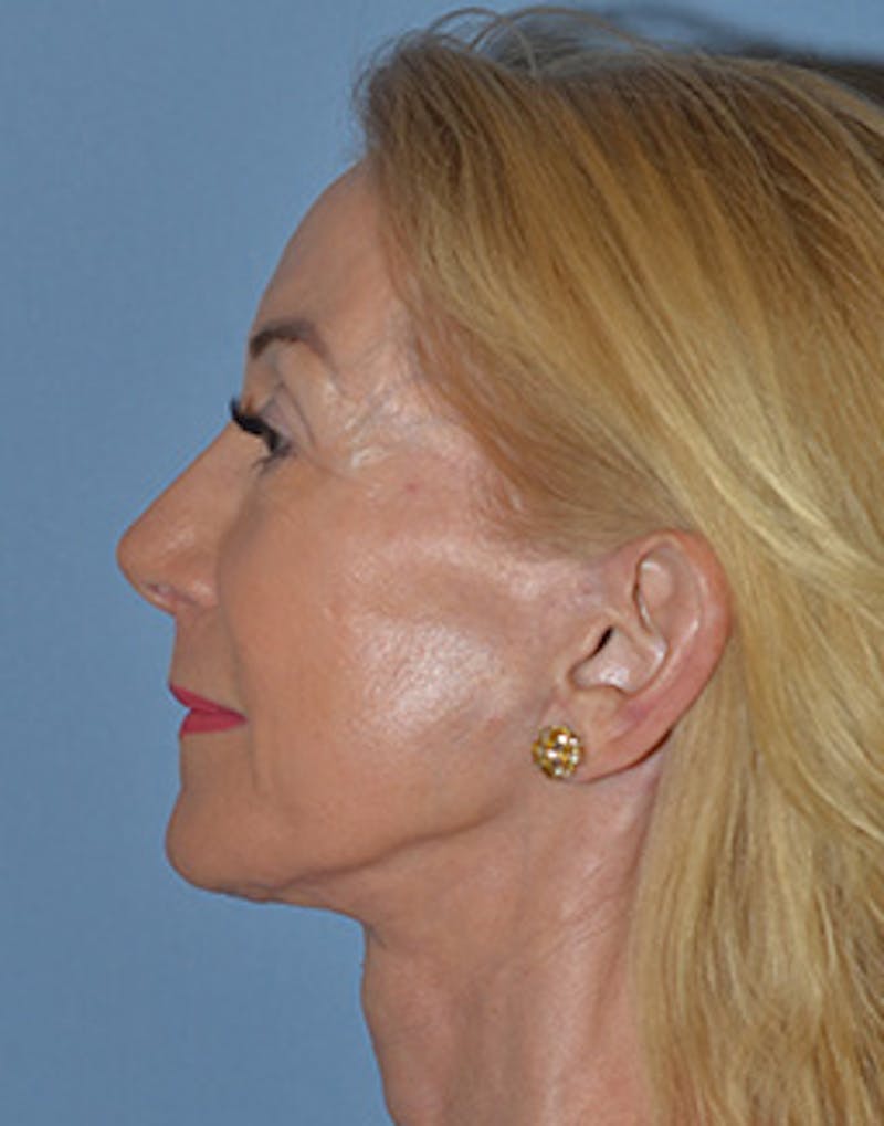 Lower Face & Neck Lift Before & After Gallery - Patient 199967 - Image 2