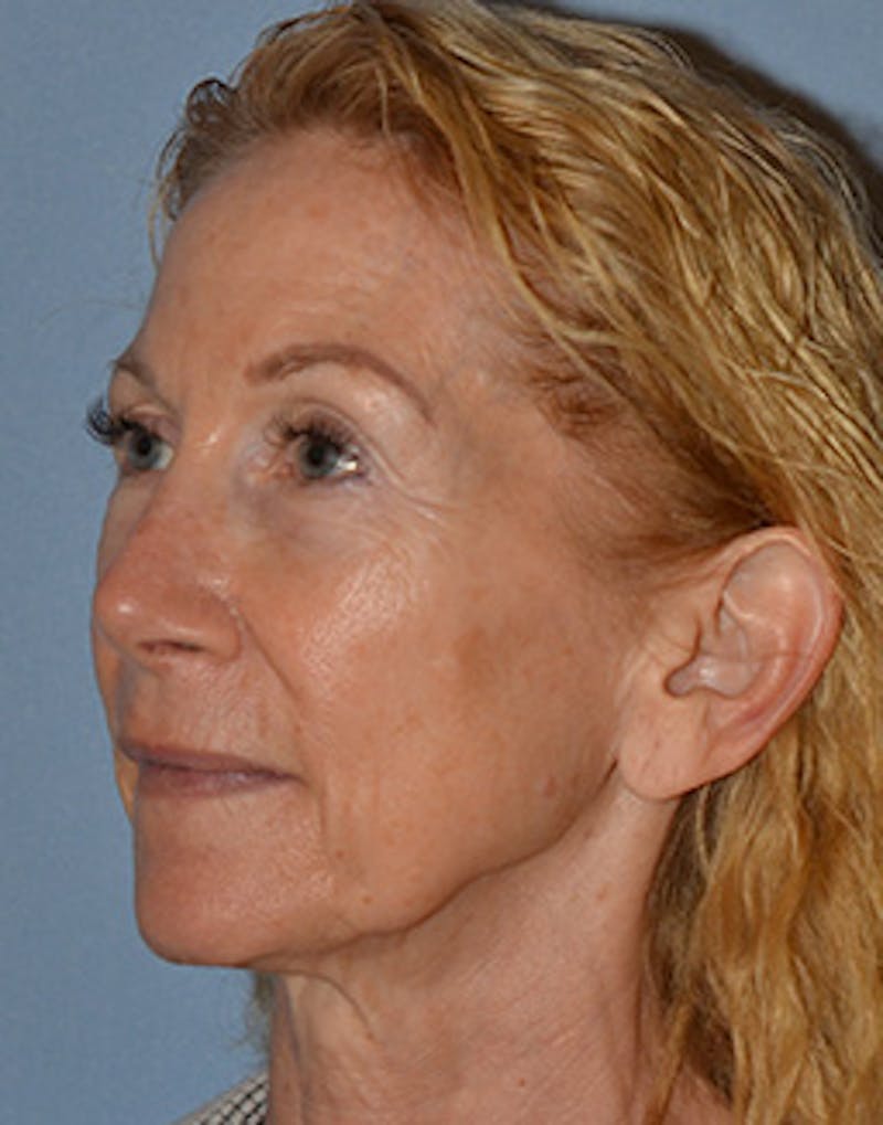 Lower Face & Neck Lift Before & After Gallery - Patient 199967 - Image 3