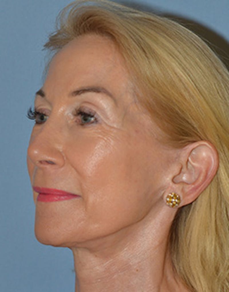 Lower Face & Neck Lift Before & After Gallery - Patient 199967 - Image 4