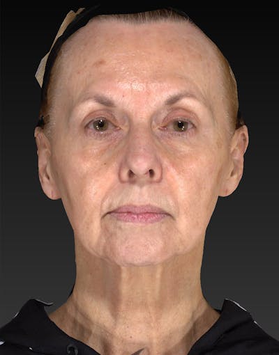 Lower Face & Neck Lift Before & After Gallery - Patient 414744 - Image 1