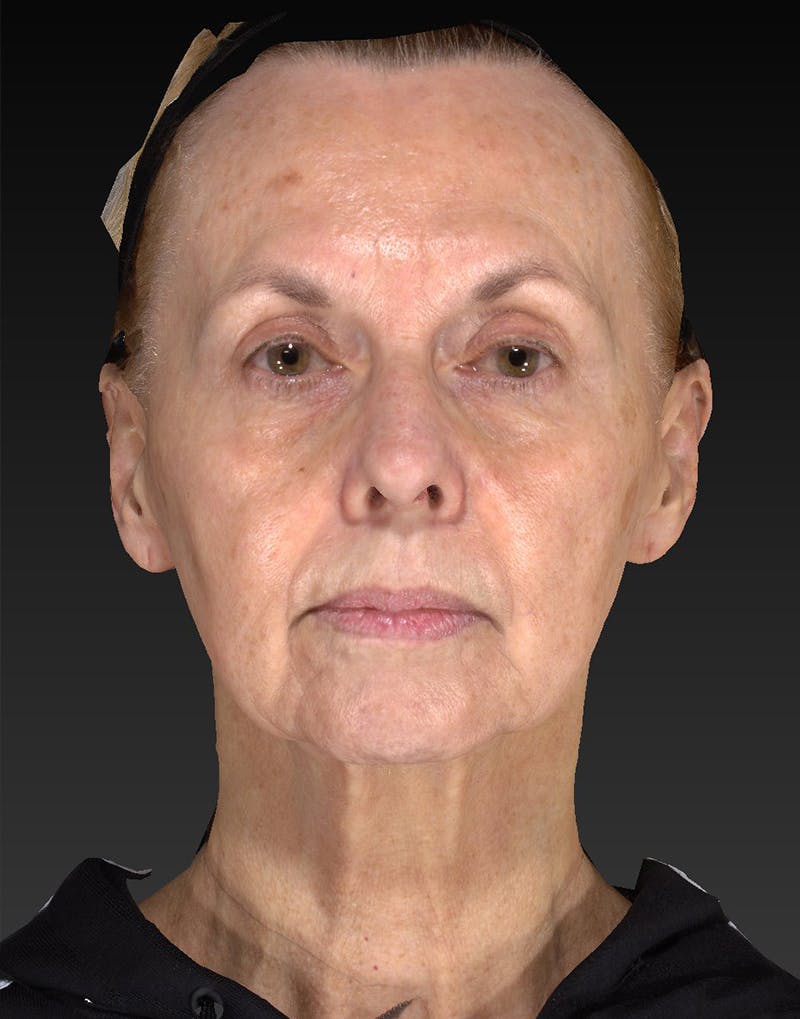 Lower Face & Neck Lift Before & After Gallery - Patient 414744 - Image 1