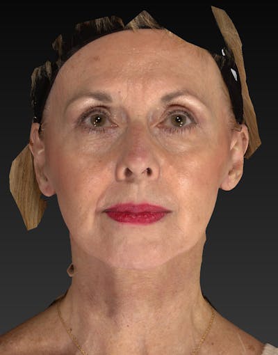 Lower Face & Neck Lift Before & After Gallery - Patient 414744 - Image 2