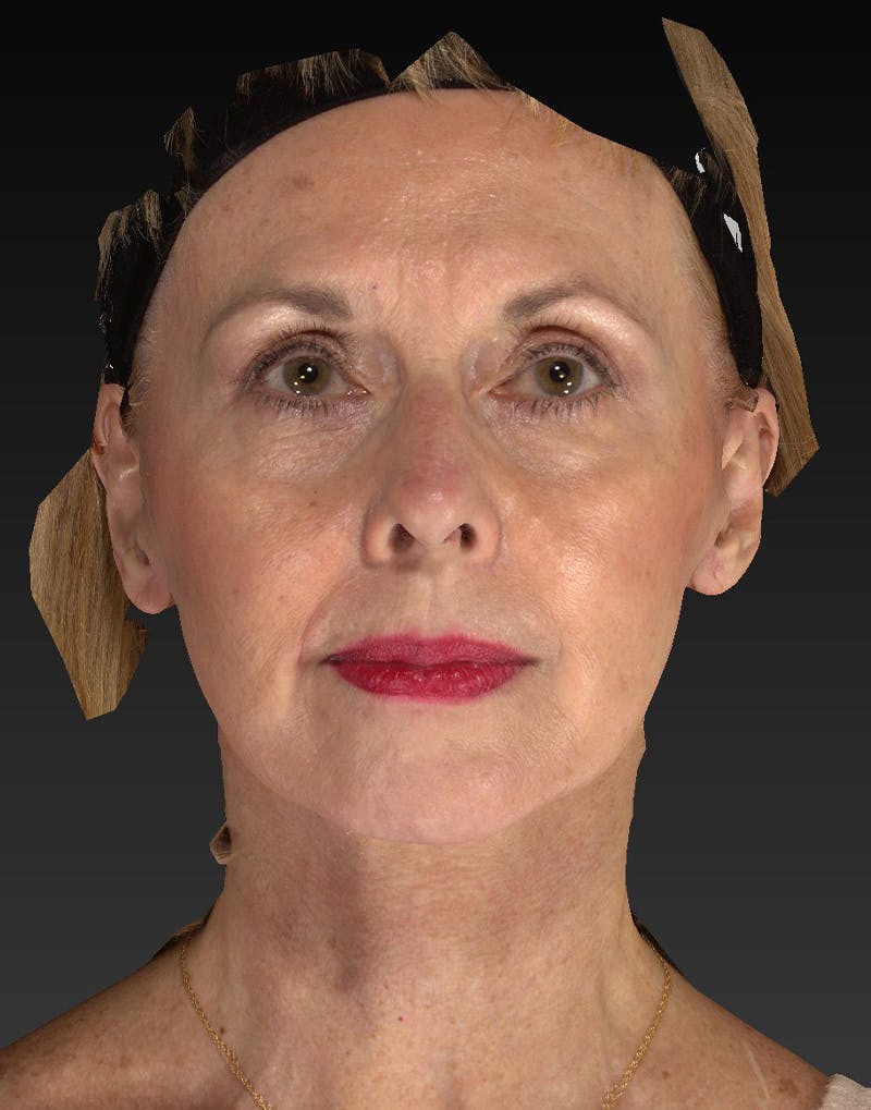 Lower Face & Neck Lift Before & After Gallery - Patient 414744 - Image 2