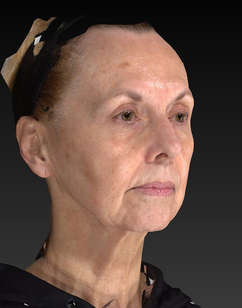 Lower Face & Neck Lift Before & After Gallery - Patient 414744 - Image 3
