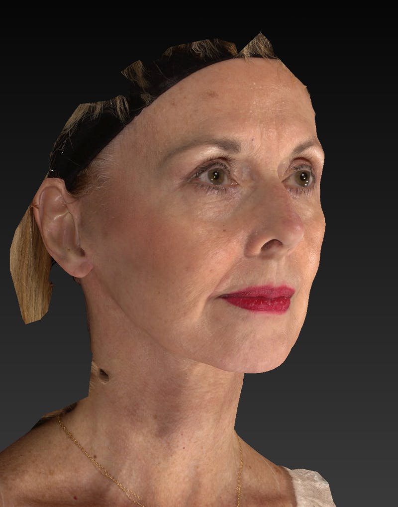 Lower Face & Neck Lift Before & After Gallery - Patient 414744 - Image 4