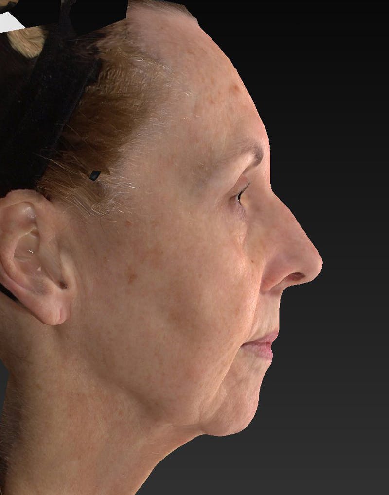 Lower Face & Neck Lift Before & After Gallery - Patient 414744 - Image 5