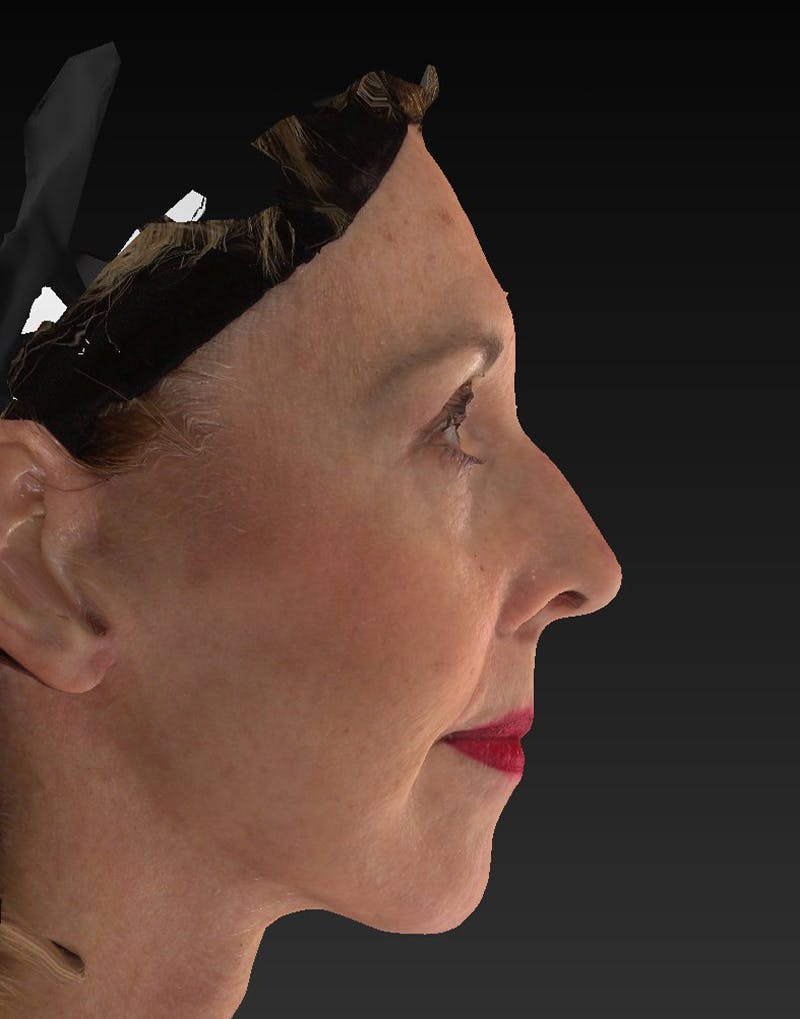 Lower Face & Neck Lift Before & After Gallery - Patient 414744 - Image 6