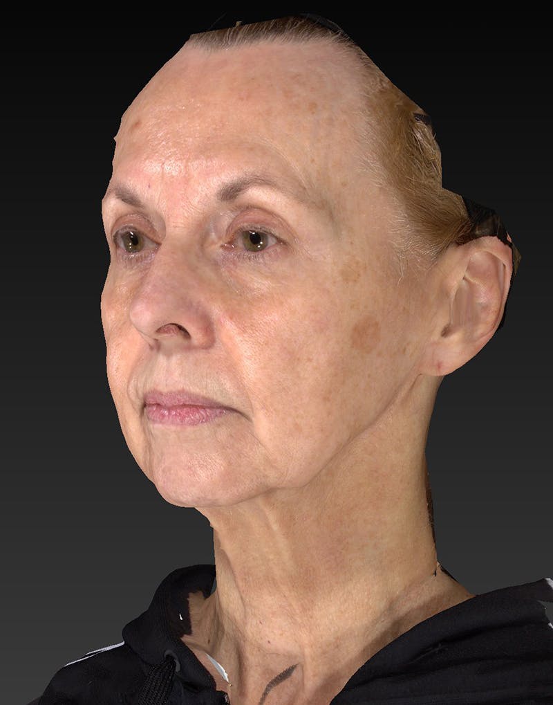 Lower Face & Neck Lift Before & After Gallery - Patient 414744 - Image 7