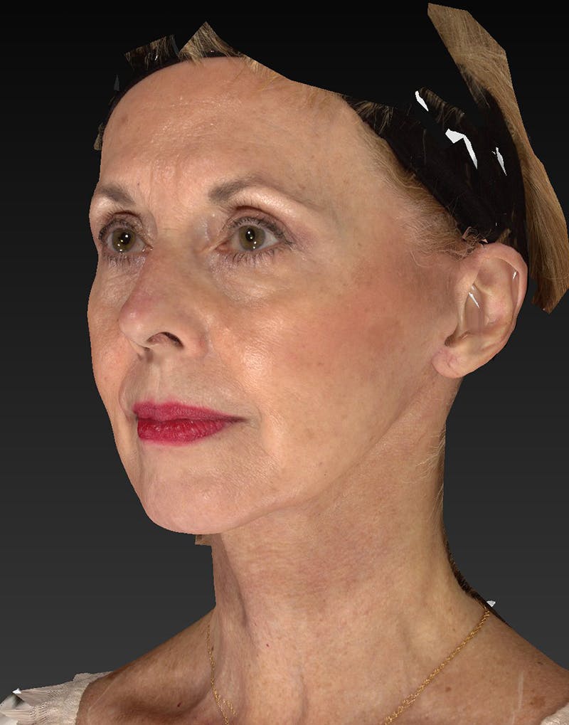 Lower Face & Neck Lift Before & After Gallery - Patient 414744 - Image 8
