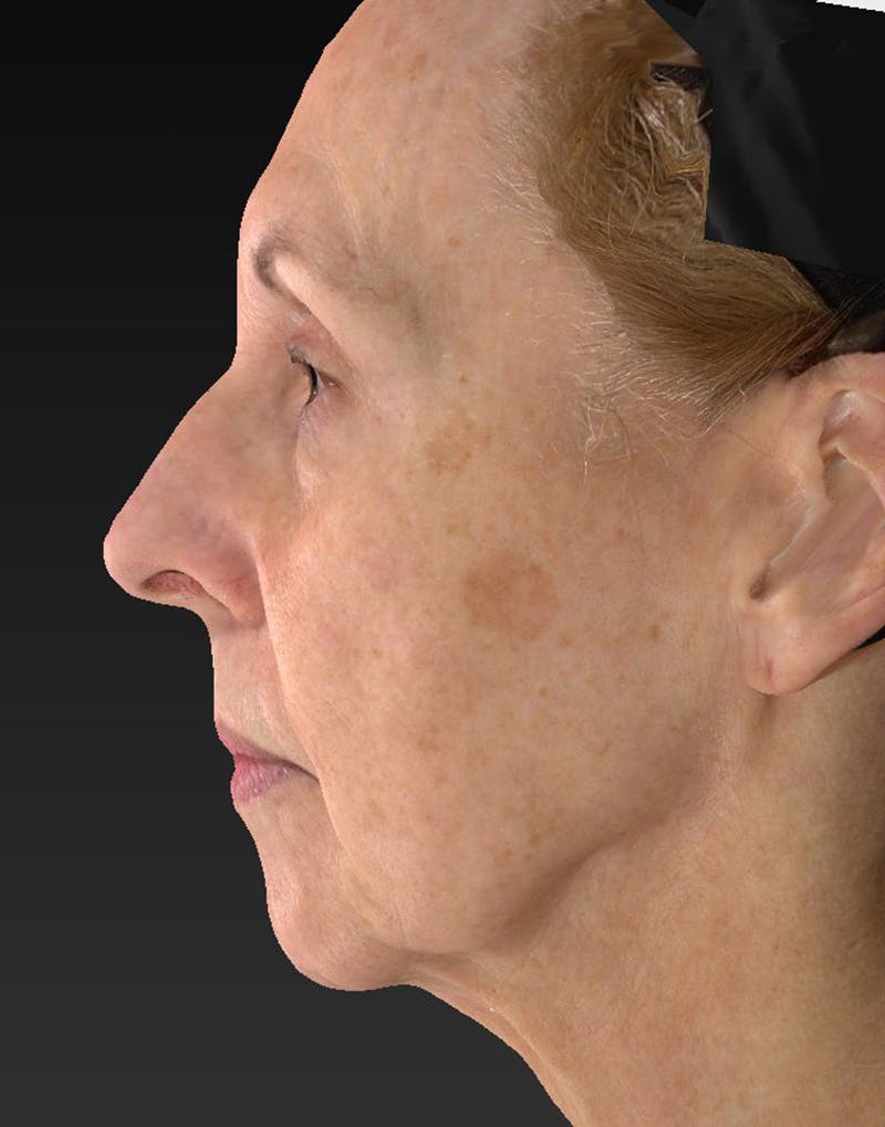 Lower Face & Neck Lift Before & After Gallery - Patient 414744 - Image 9