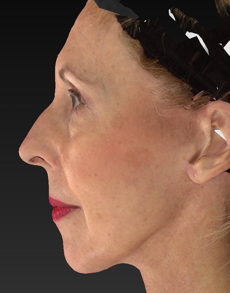 Lower Face & Neck Lift Before & After Gallery - Patient 414744 - Image 10