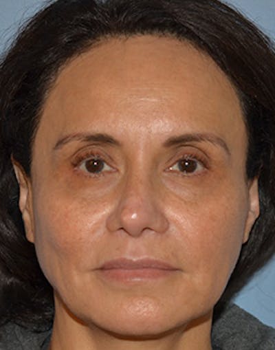 Mini Facelift Before & After Gallery - Patient 403008 - Image 1