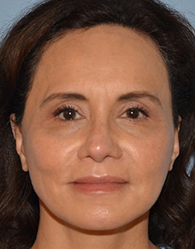 Mini Facelift Before & After Gallery - Patient 403008 - Image 2