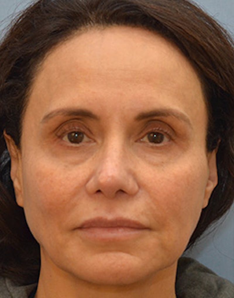 Mini Facelift Before & After Gallery - Patient 403008 - Image 3