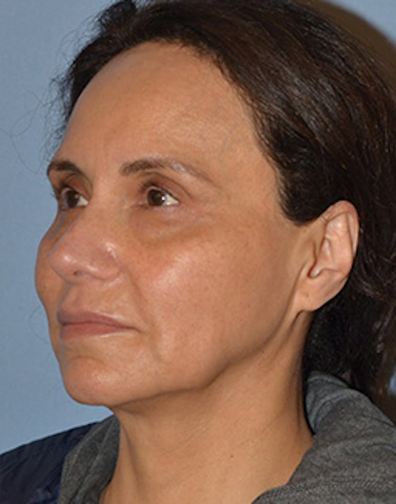 Mini Facelift Before & After Gallery - Patient 403008 - Image 5