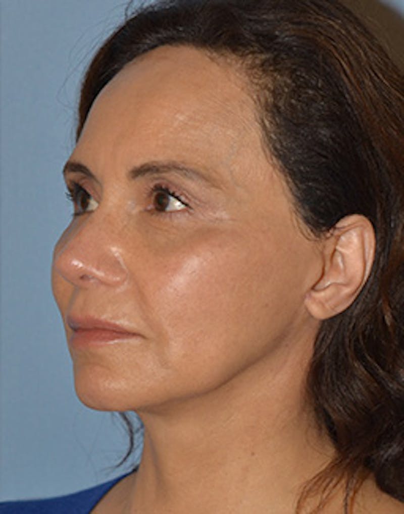 Mini Facelift Before & After Gallery - Patient 403008 - Image 6