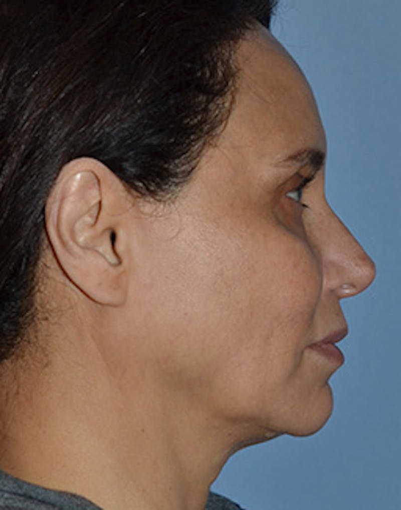 Mini Facelift Before & After Gallery - Patient 403008 - Image 7