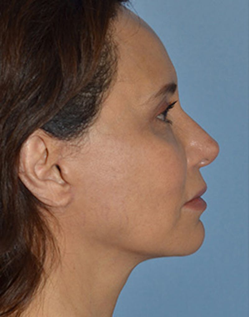 Mini Facelift Before & After Gallery - Patient 403008 - Image 8