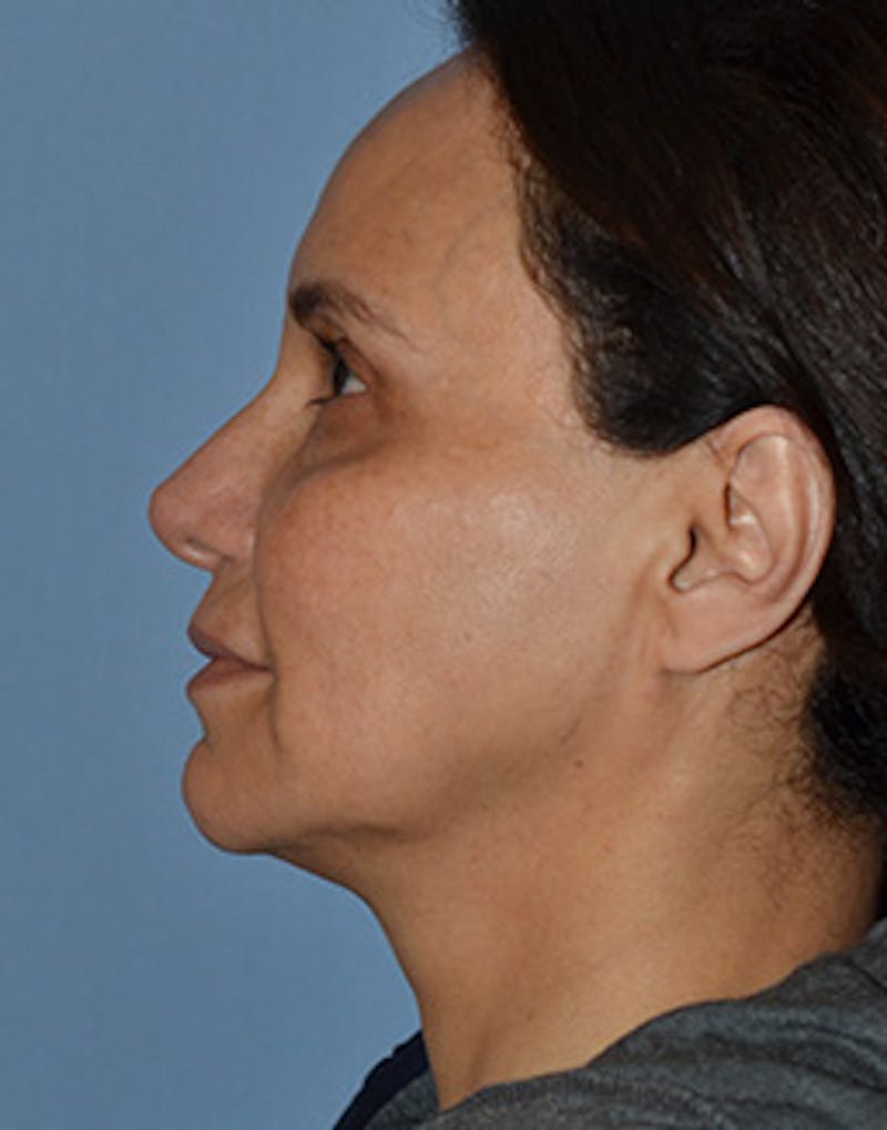 Mini Facelift Before & After Gallery - Patient 403008 - Image 9