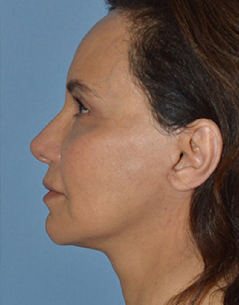 Mini Facelift Before & After Gallery - Patient 403008 - Image 10