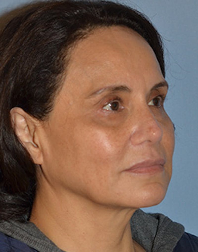Mini Facelift Before & After Gallery - Patient 403008 - Image 11