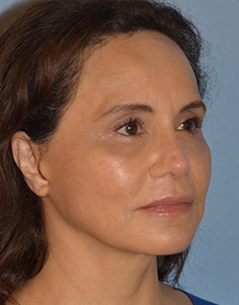 Mini Facelift Before & After Gallery - Patient 403008 - Image 12
