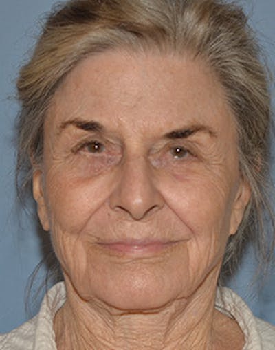 Mini Facelift Before & After Gallery - Patient 720479 - Image 1