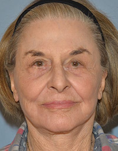 Mini Facelift Before & After Gallery - Patient 720479 - Image 2
