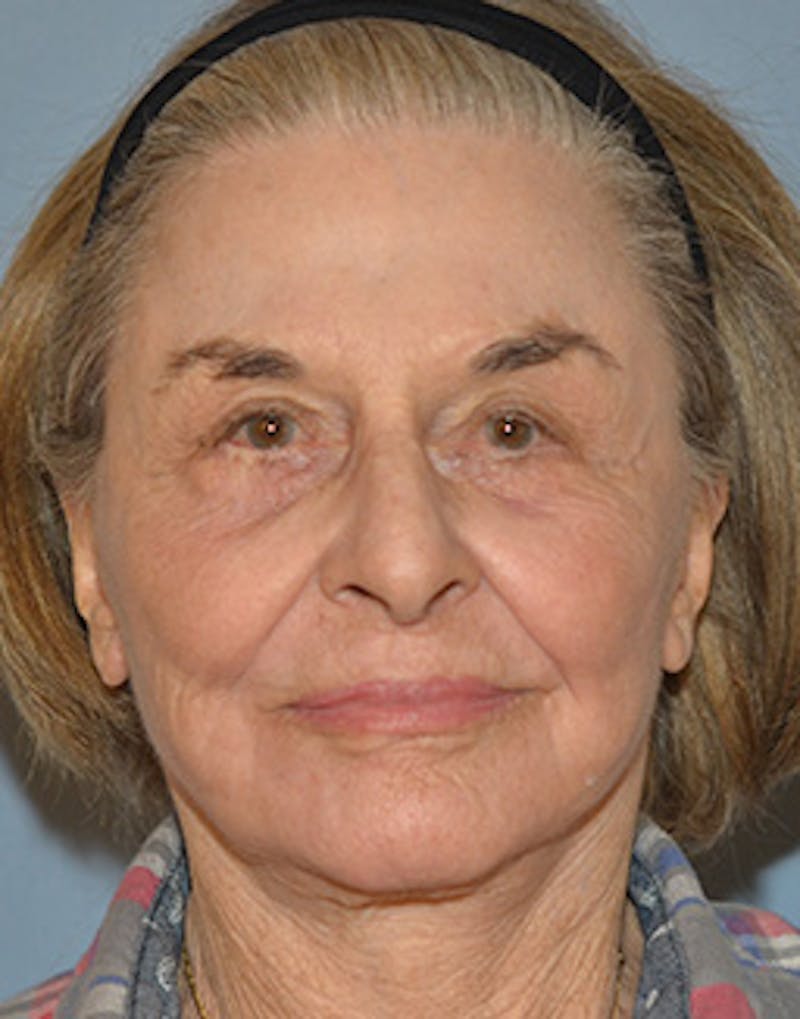 Mini Facelift Before & After Gallery - Patient 720479 - Image 2