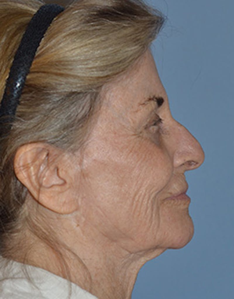 Mini Facelift Before & After Gallery - Patient 720479 - Image 3