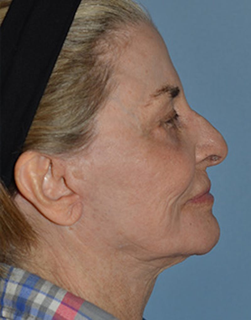 Mini Facelift Before & After Gallery - Patient 720479 - Image 4