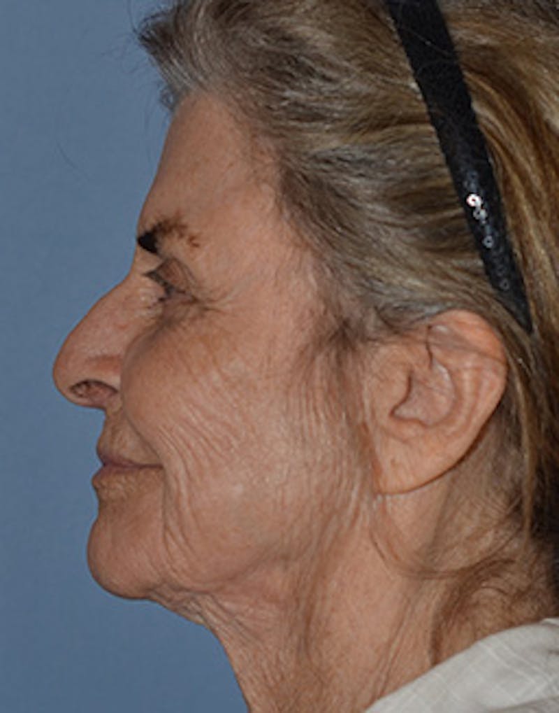 Mini Facelift Before & After Gallery - Patient 720479 - Image 5