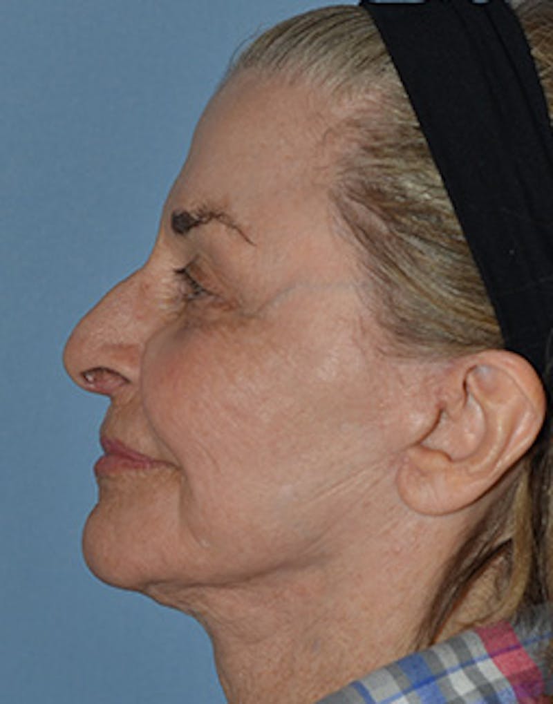 Mini Facelift Before & After Gallery - Patient 720479 - Image 6