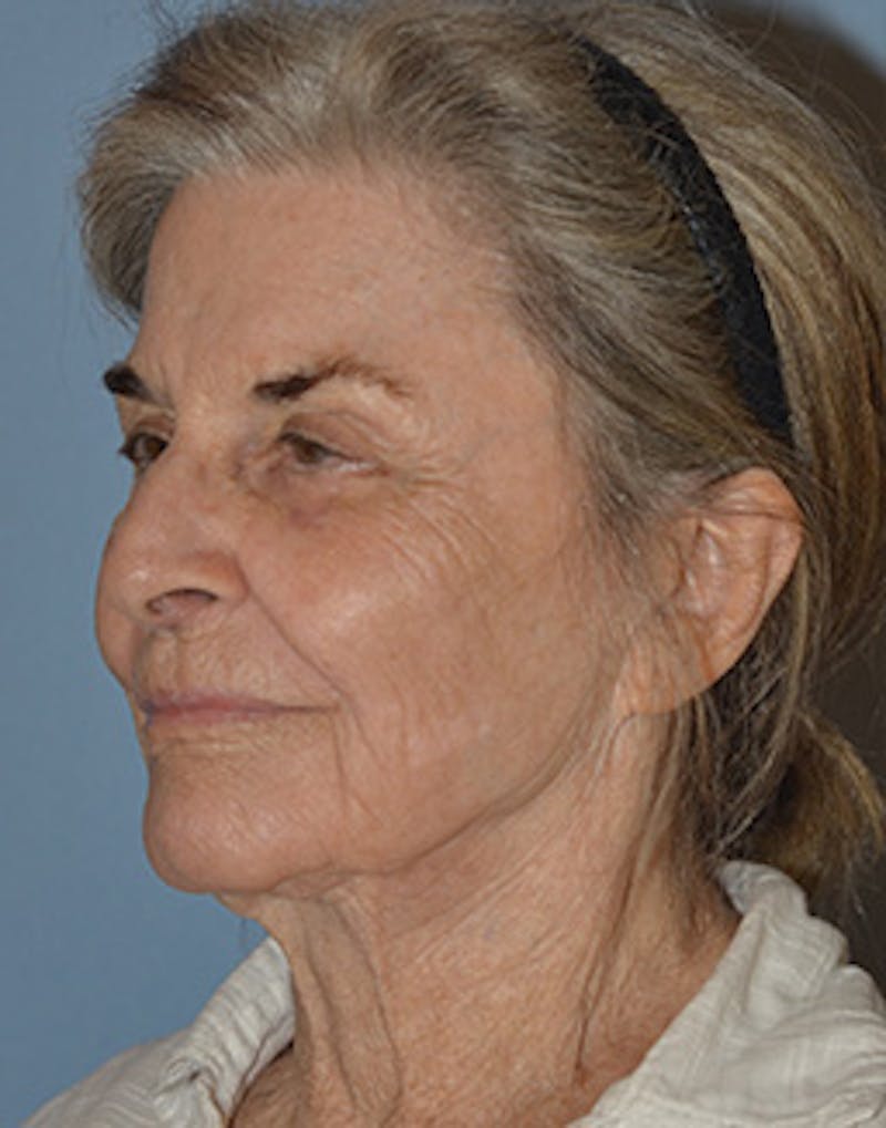 Mini Facelift Before & After Gallery - Patient 720479 - Image 7