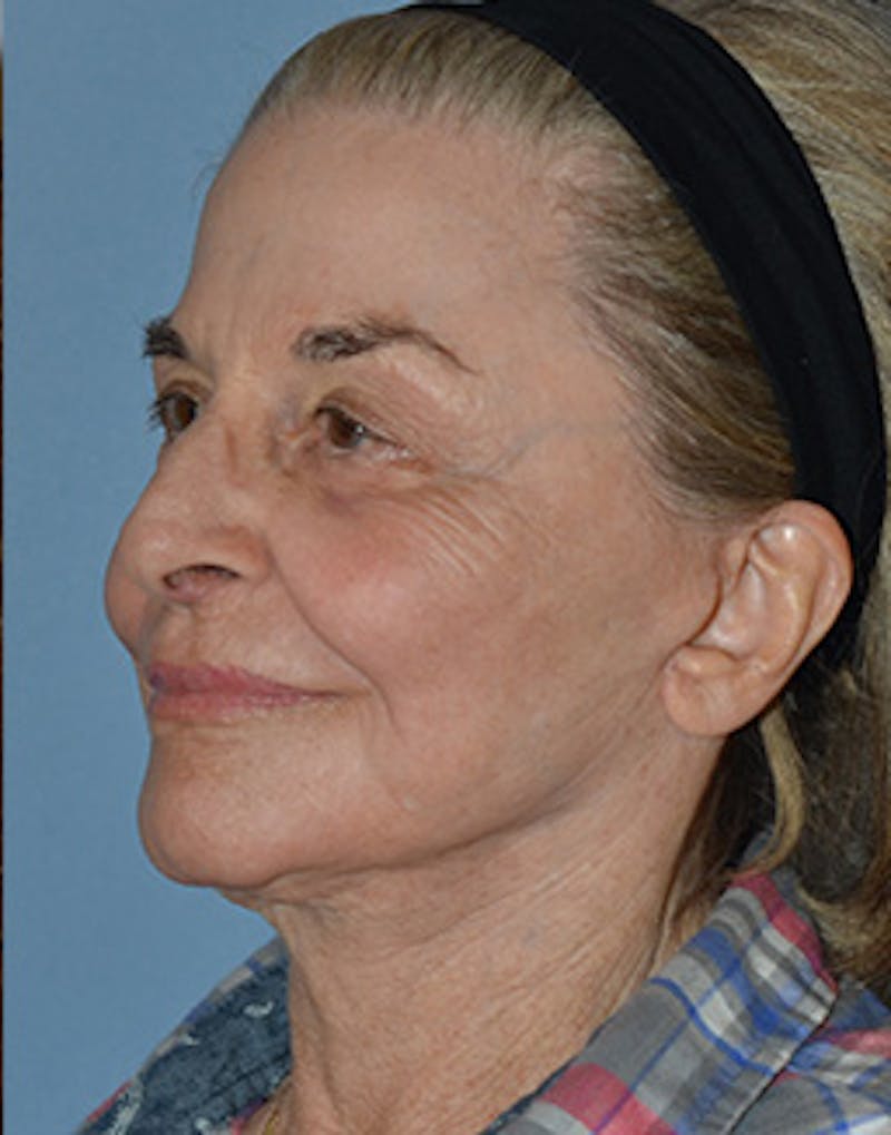 Mini Facelift Before & After Gallery - Patient 720479 - Image 8